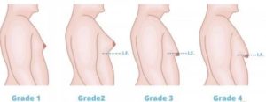 Gynecomastia Grading