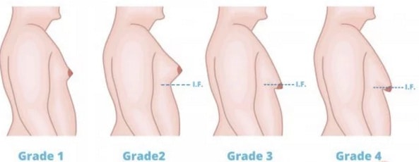 Round Boobs in Male, Gynecomastia Grade-2, Surat, Gujarat, India.