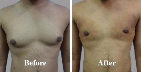 Bilateral Gynecomastia Before After
