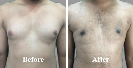 Gynecomastia Male Chest Reduction India Before After Photo