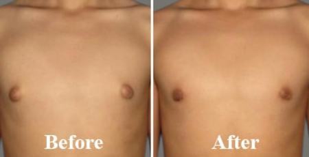Gynecomastia - Male Breast Reduction Surgery - Cost & Results Before After Photo The patient is shown 6 months after his breast reduction procedure. What is gynecomastia surgery? Gynecomastia surgery reduces breast size in men